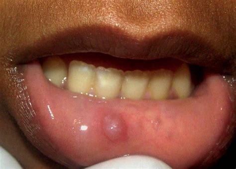 Mucous cyst, often called mucocele, is a fluid-filled swelling that appears in your mouth and inside of your lip. . Accidentally popped mucocele